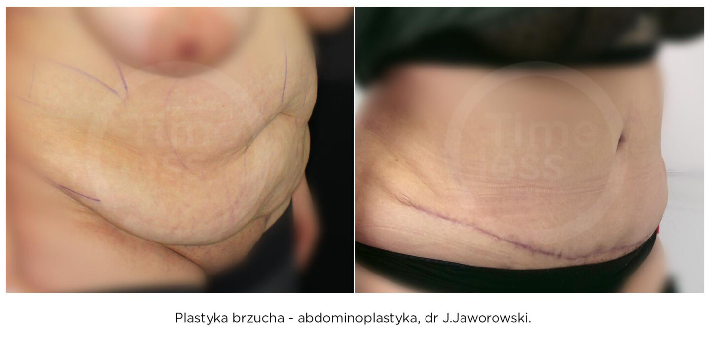 abdominoplastyka efekty przed i po operacji