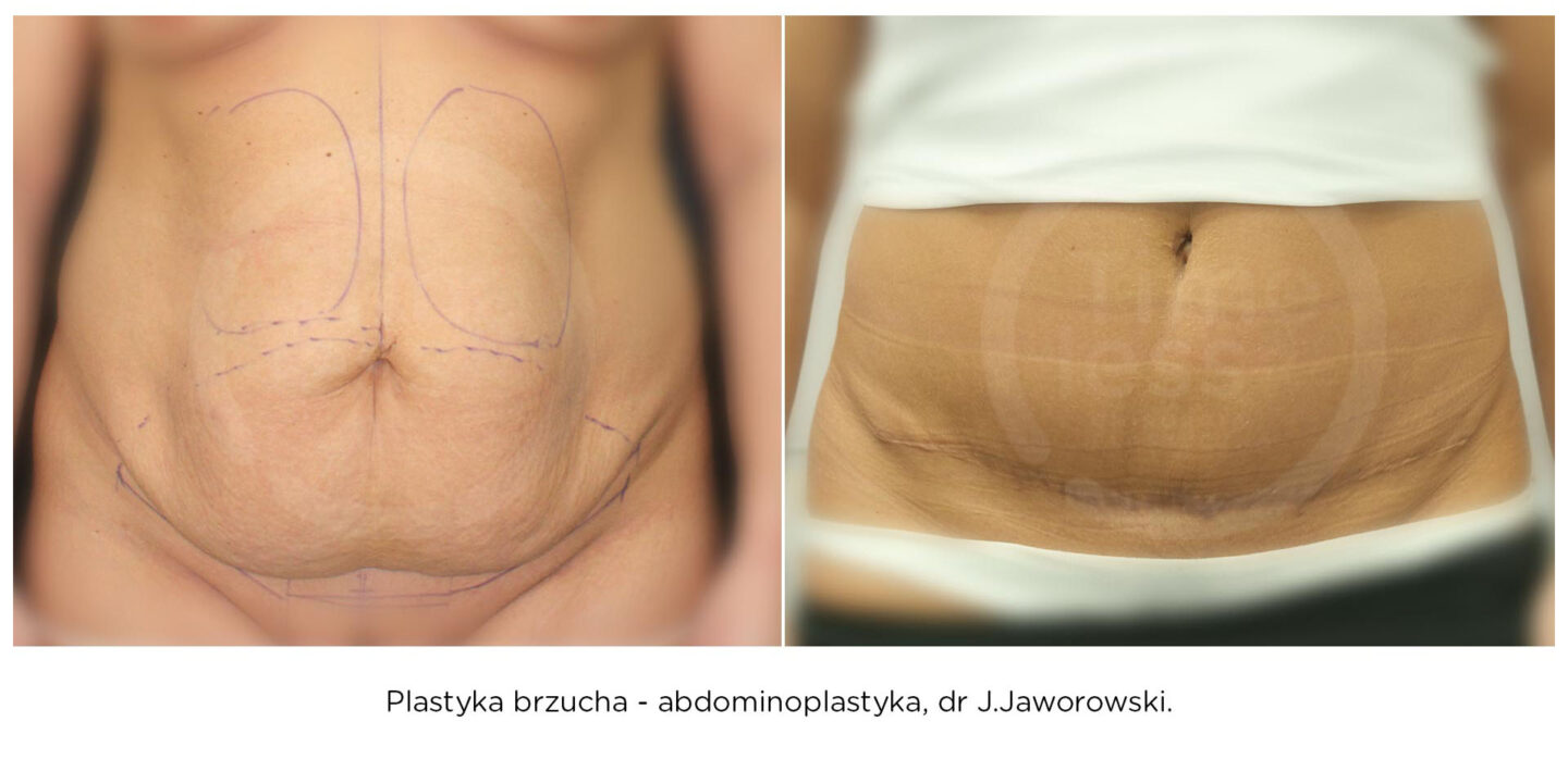 abdominoplastyka zobacz efekt przed i po operacji