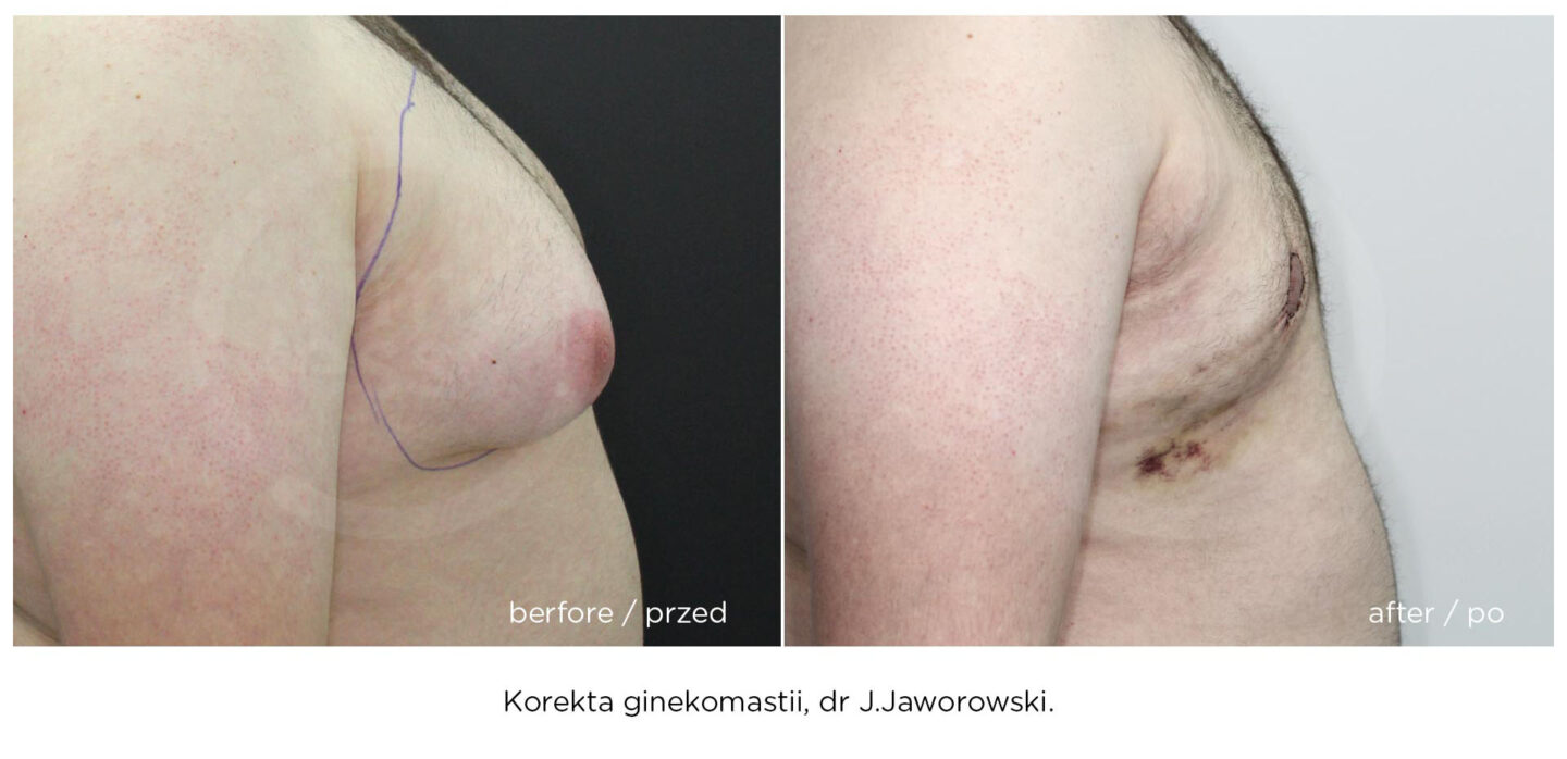 ginekomastia zobacz efekt przed i po operacji