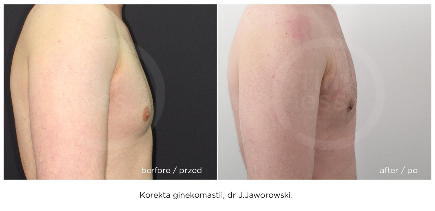 ginekomastia efekt przed i po operacji