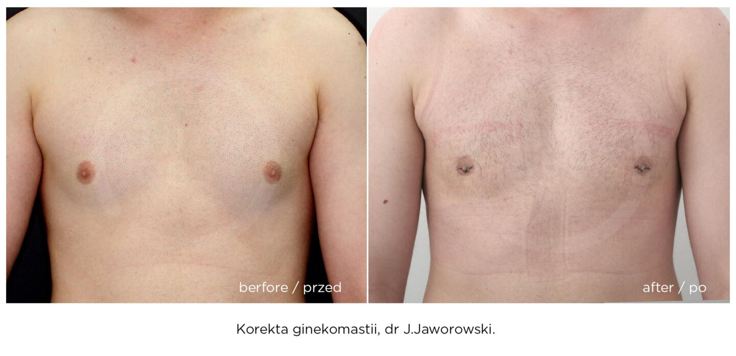 ginekomastia efekt przed i po operacji