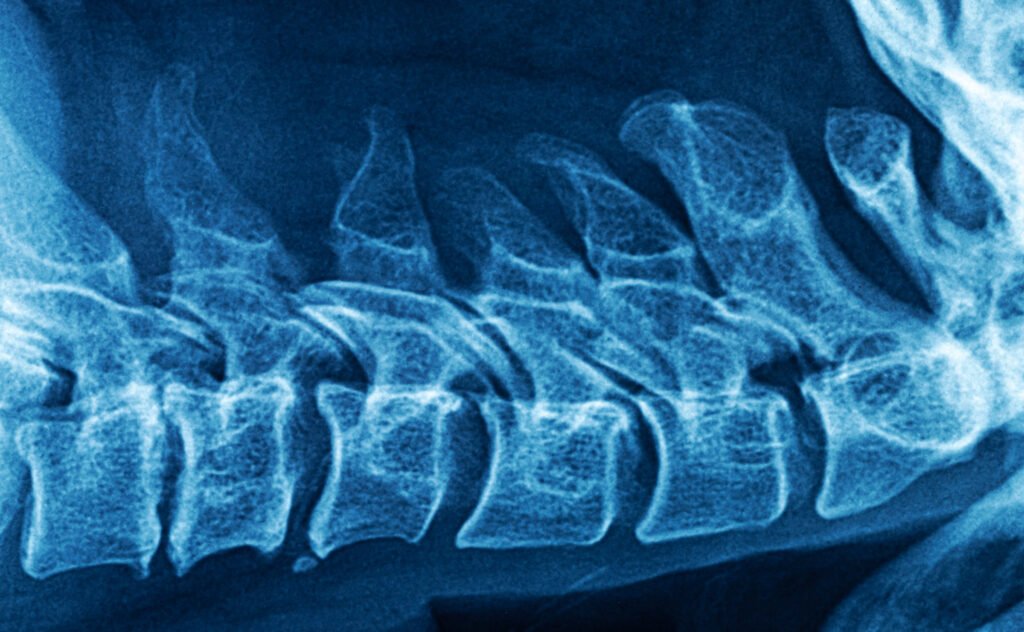 Metoda leczenia dużych ubytków tkanki kostnej u&nbsp;chorych onkologicznych z&nbsp;wykorzystaniem inżynierii tkankowej in&nbsp;vivo