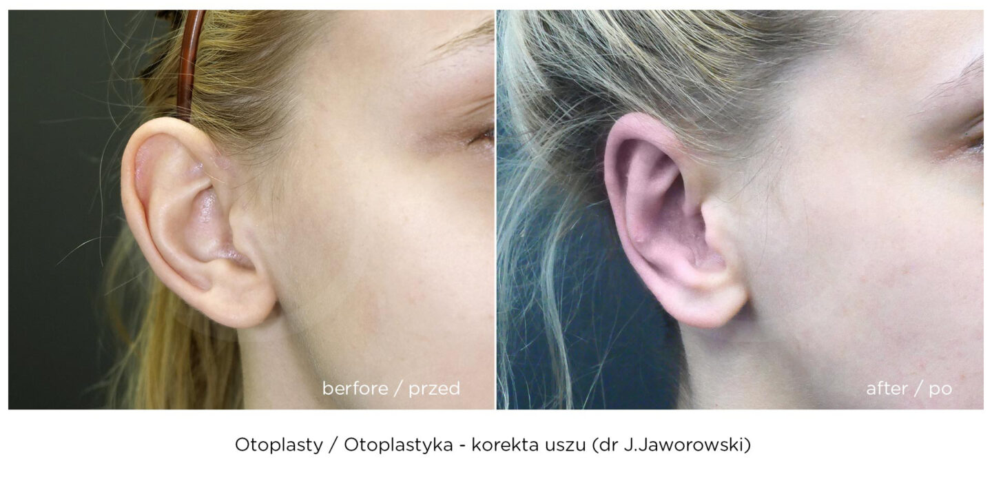 otoplastyka korekta uszu zobacz efekt przed i po