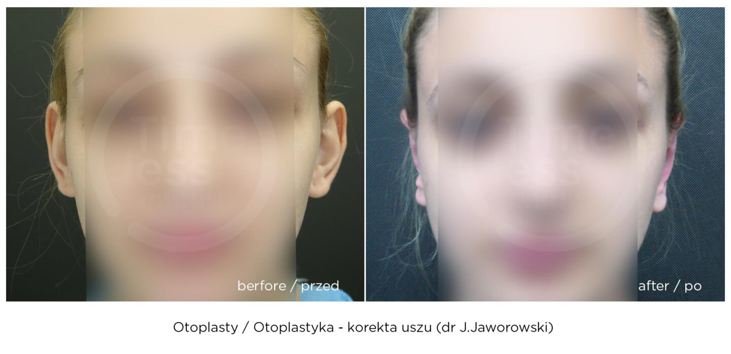 korekta uszu efekt przed i po zabiegu