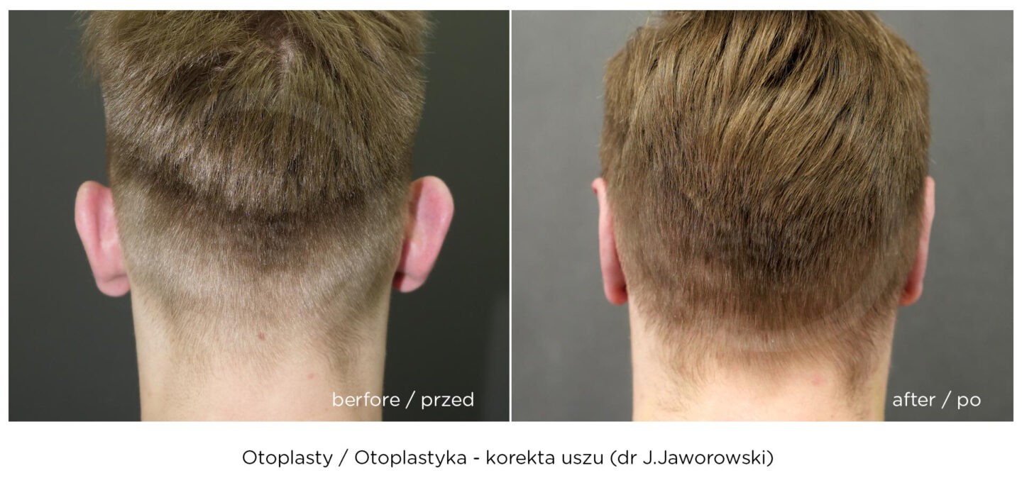 otoplastyka korekta uszu efekt przed i po