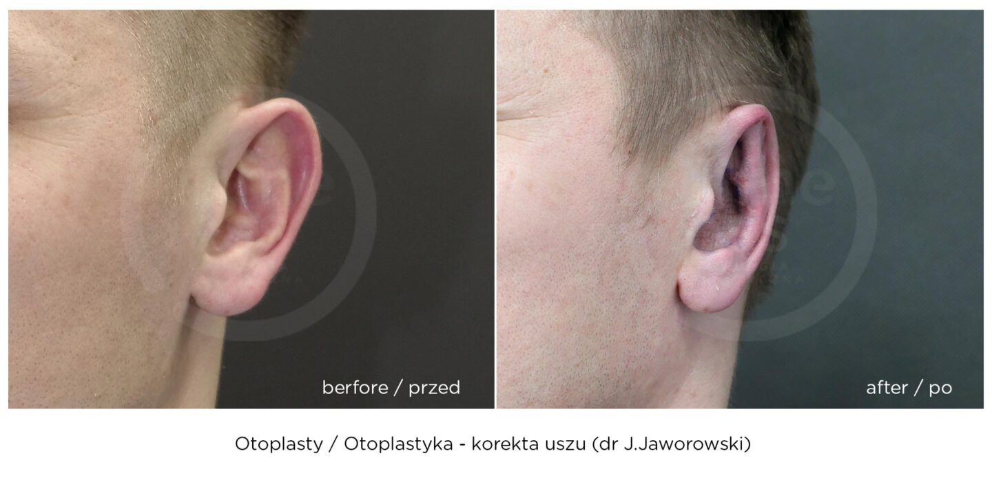 otoplastyka korekta uszu efekt przed i po