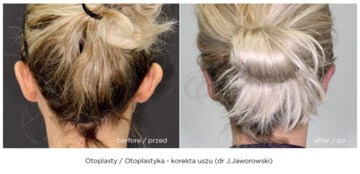 otoplastyka korekta uszu zobacz efekt przed i po