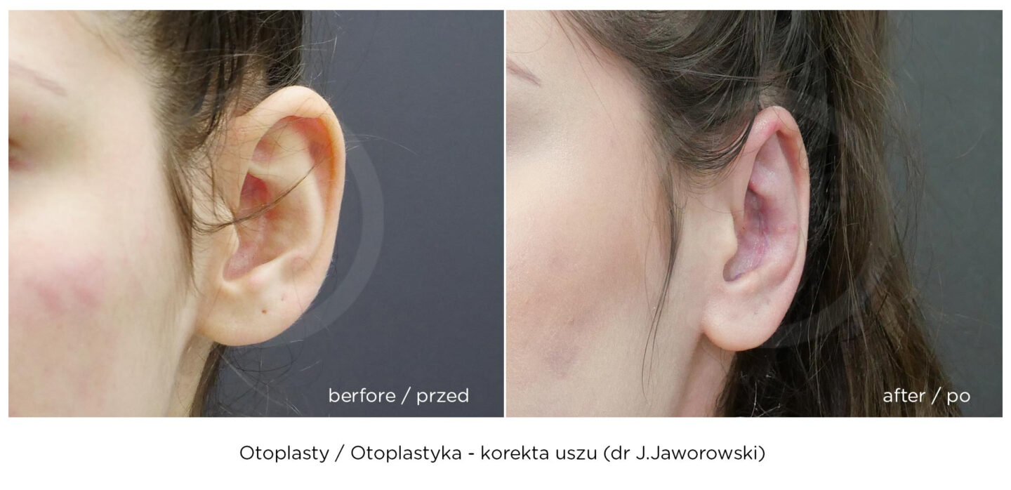 otoplastyka korekta uszu efekt przed i po zabiegu