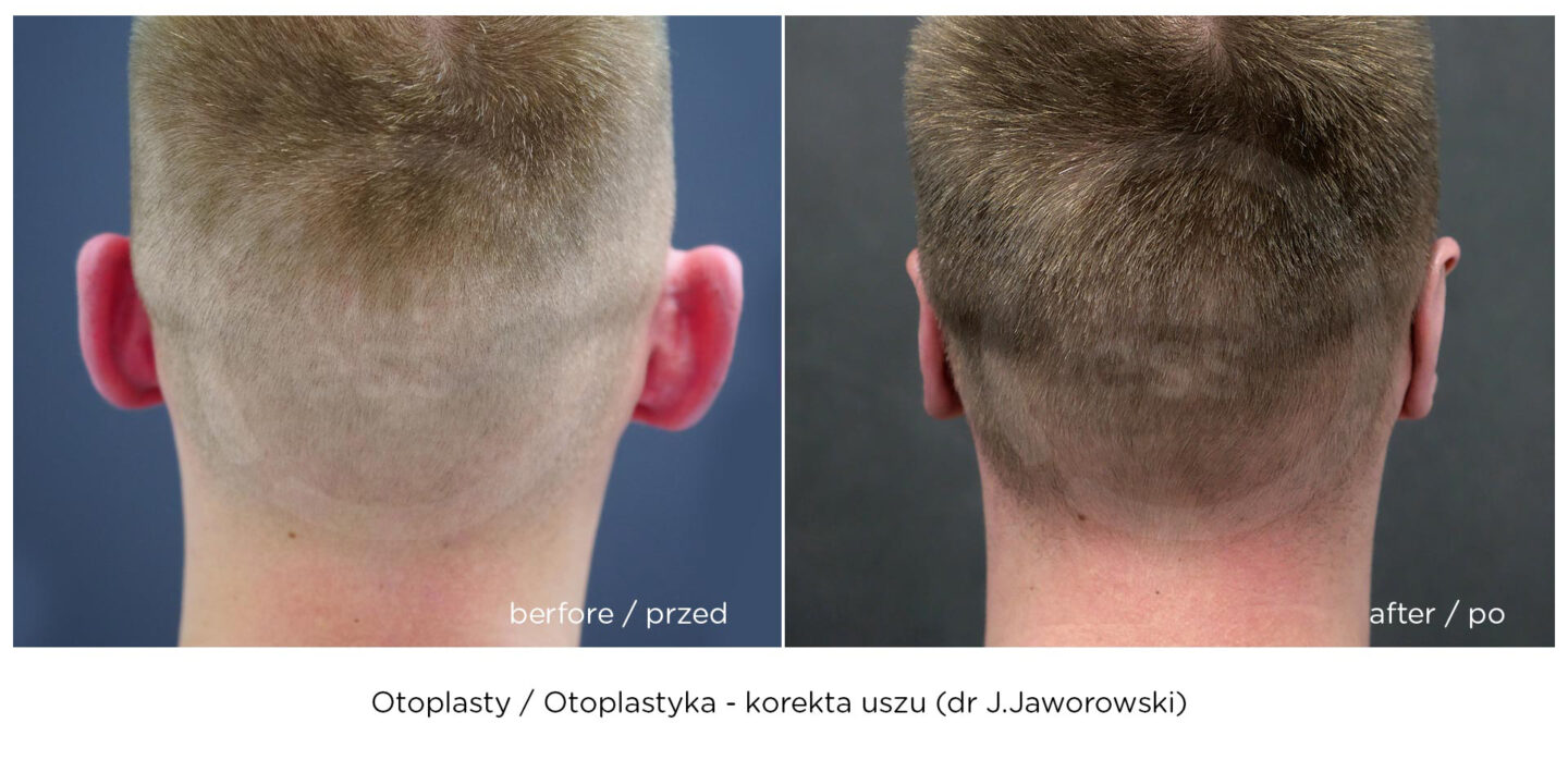 otoplastyka korekta uszu warszawa efekt przed i po