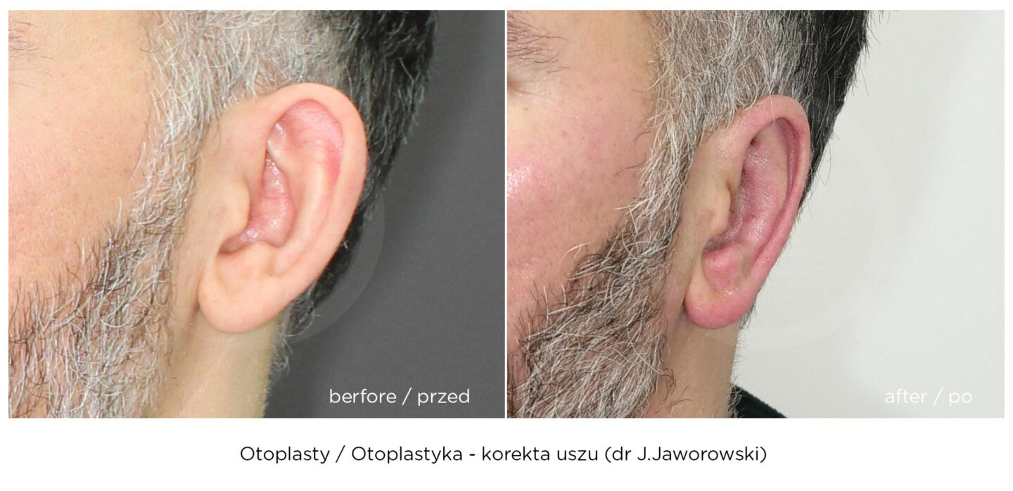 otoplastyka korekta uszu efekt przed i po zabiegu