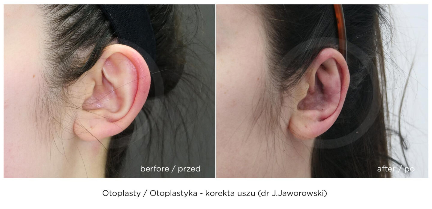 korekta uszu efekt przed i po zabiegu
