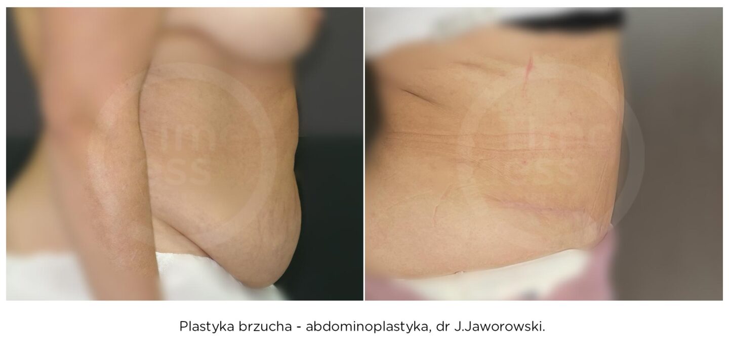 plastyka brzucha abdominoplastyka w warszawie zobacz przed i po operacji