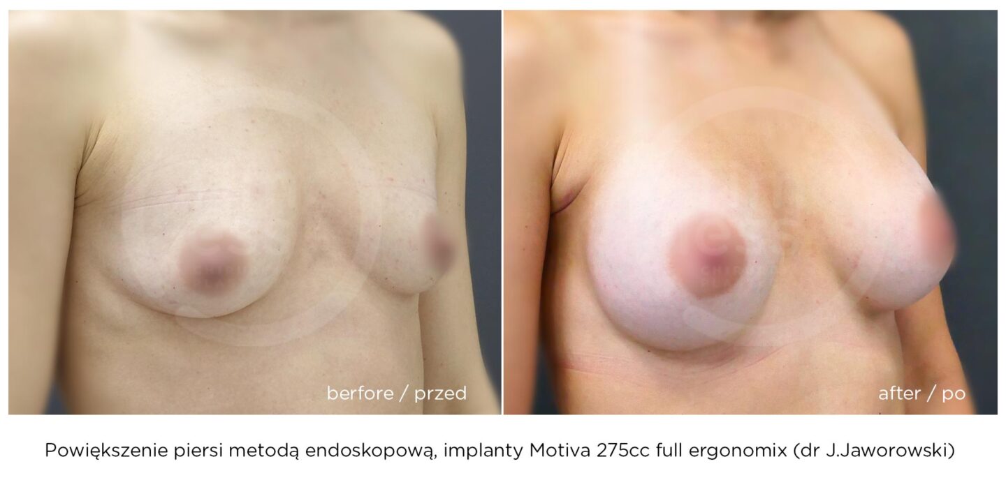 endoskopowe powiększanie piersi w warszawie przed i po operacji