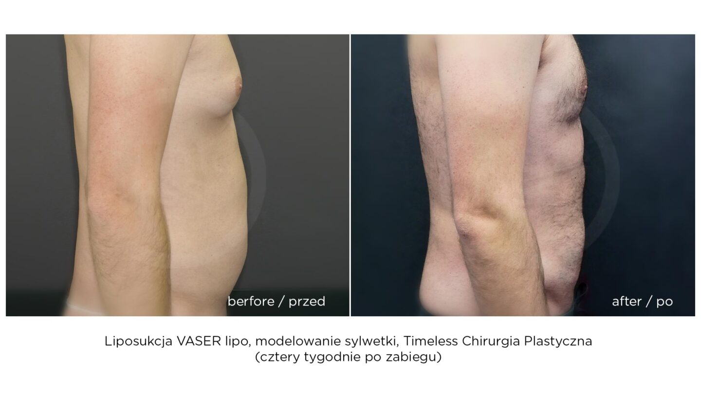 Modelowanie sylwetki Vaser Lipo HD u mężczyzn warszawa - przed i po