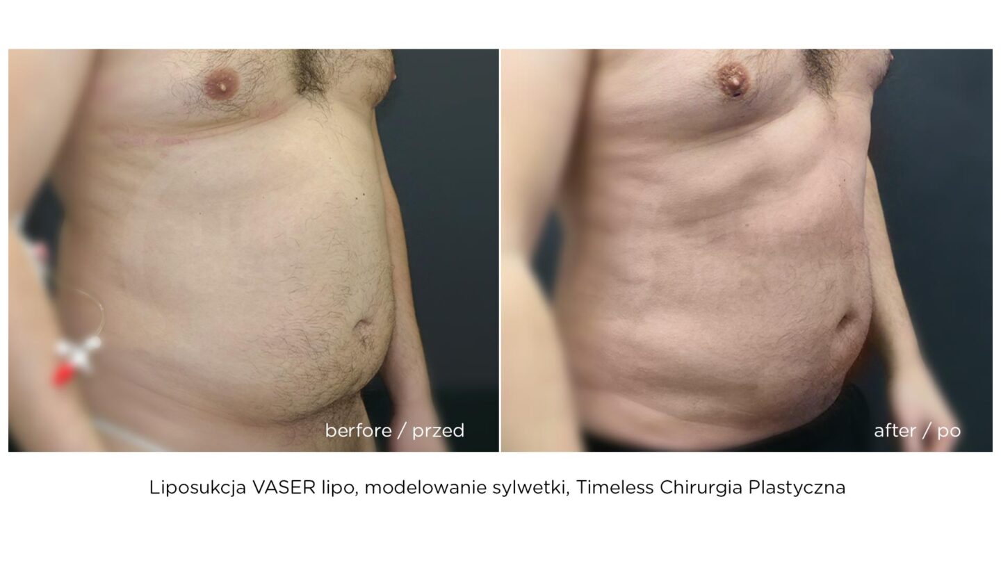 Modelowanie sylwetki Vaser Lipo HD u mężczyzn warszawa - efekt przed i po