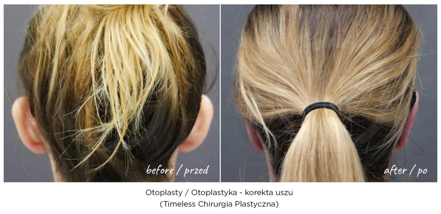 Otoplastyka, korekta uszu warszawa - efekt przed i po