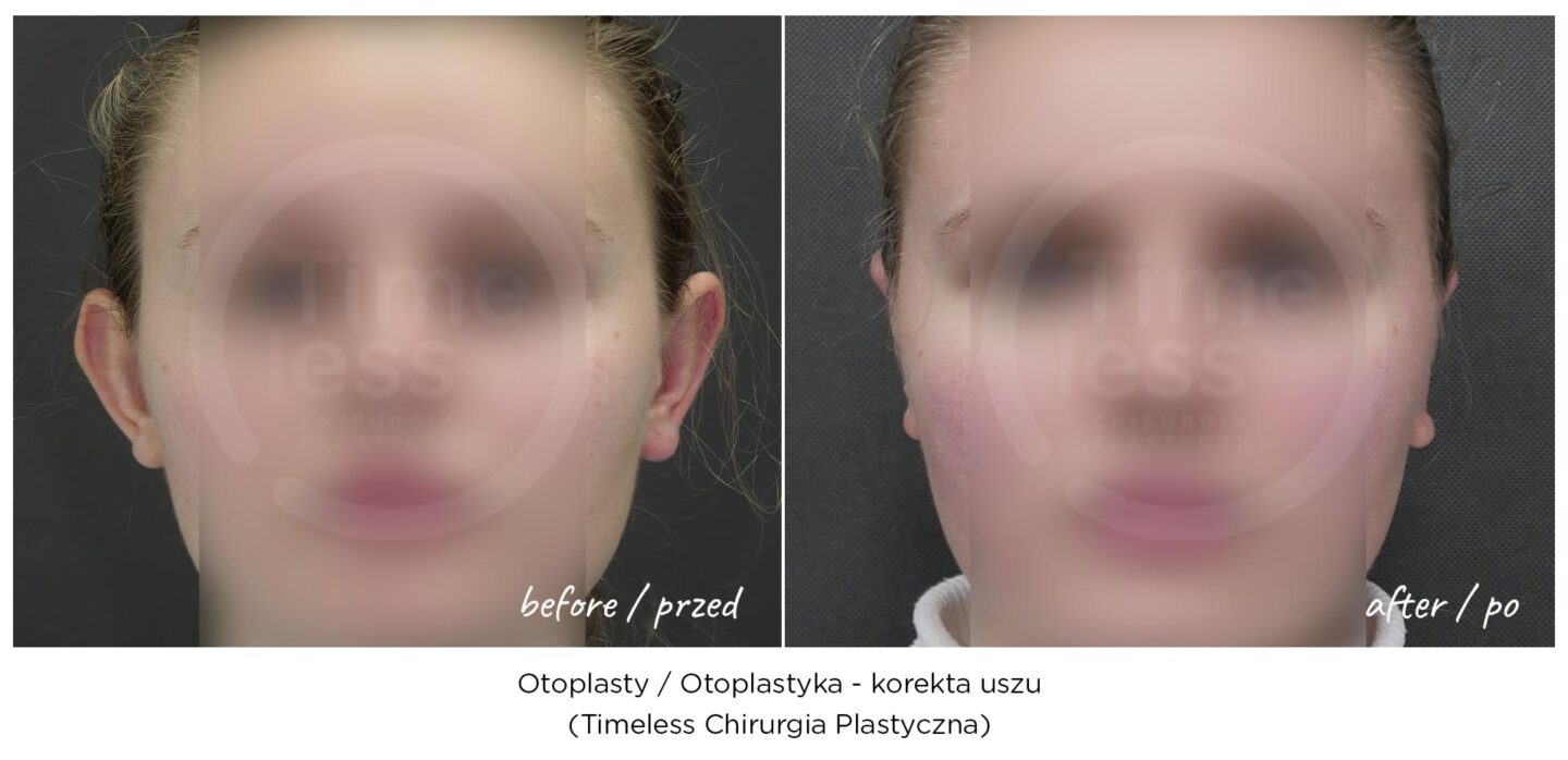 Otoplastyka, korekta uszu warszawa - efekt przed i po