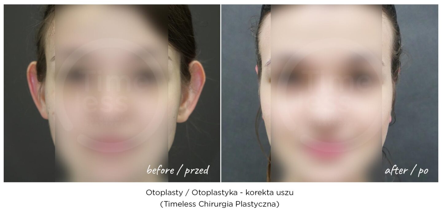 Otoplastyka, korekta uszu warszawa - przed i po zabiegach