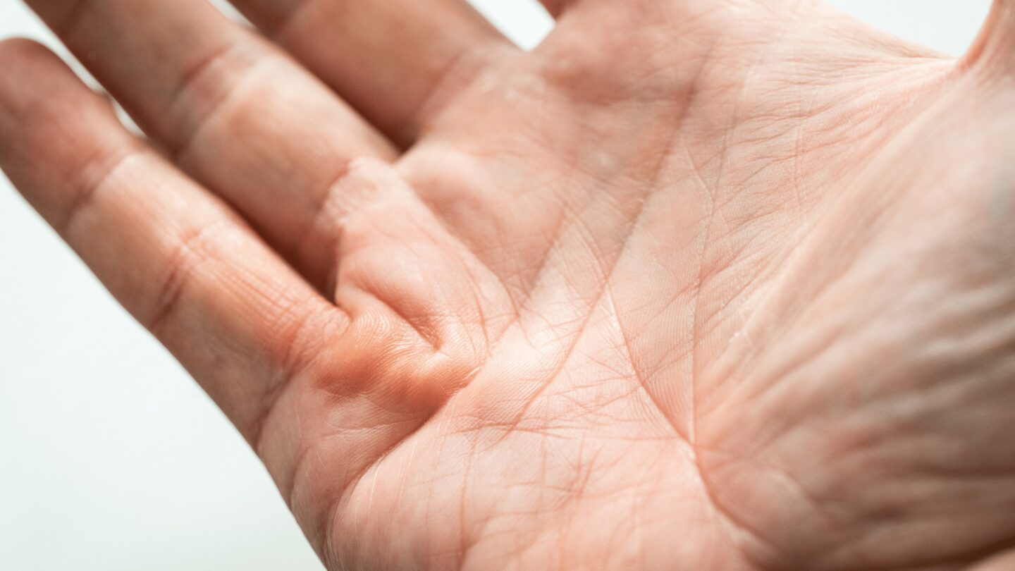 leczenie przykurczu ręki warszawa