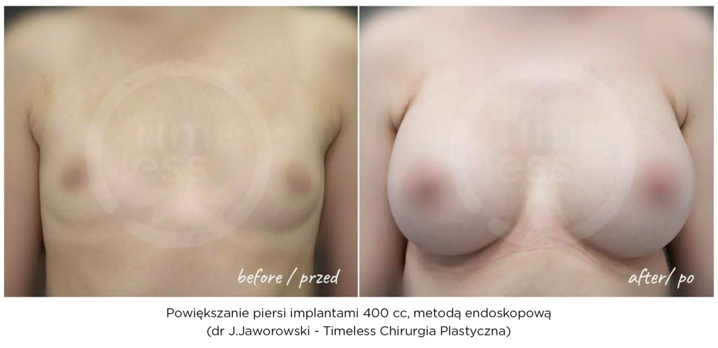 powiększanie piersi metodą endoskopową w Warszawie - efekt po operacji