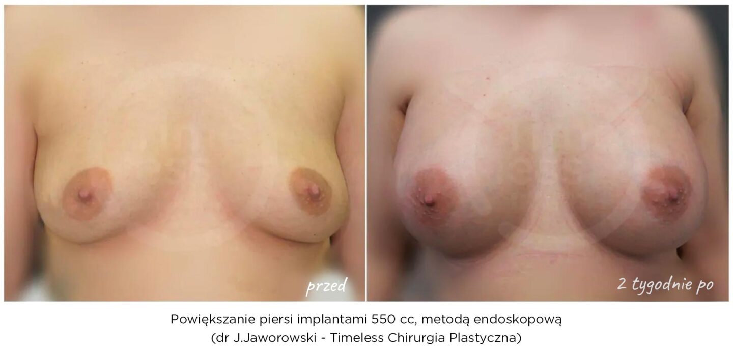 powiększanie piersi metodą endoskopową w Warszawie - efekt po operacji