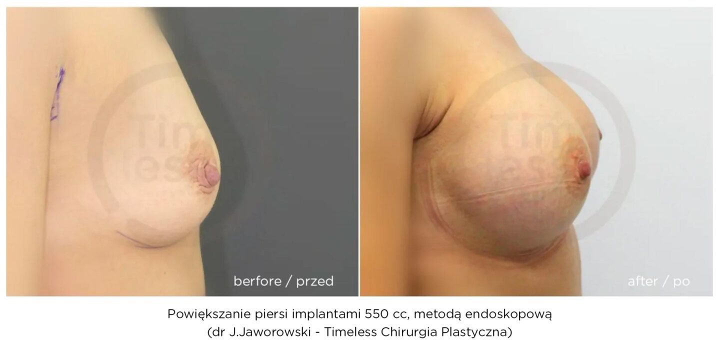 powiększanie piersi metodą endoskopową w Warszawie dr Janusz Jaworowski