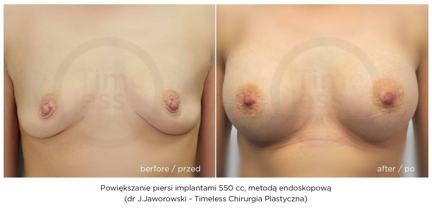 powiększanie piersi metodą endoskopową w Warszawie dr Janusz Jaworowski