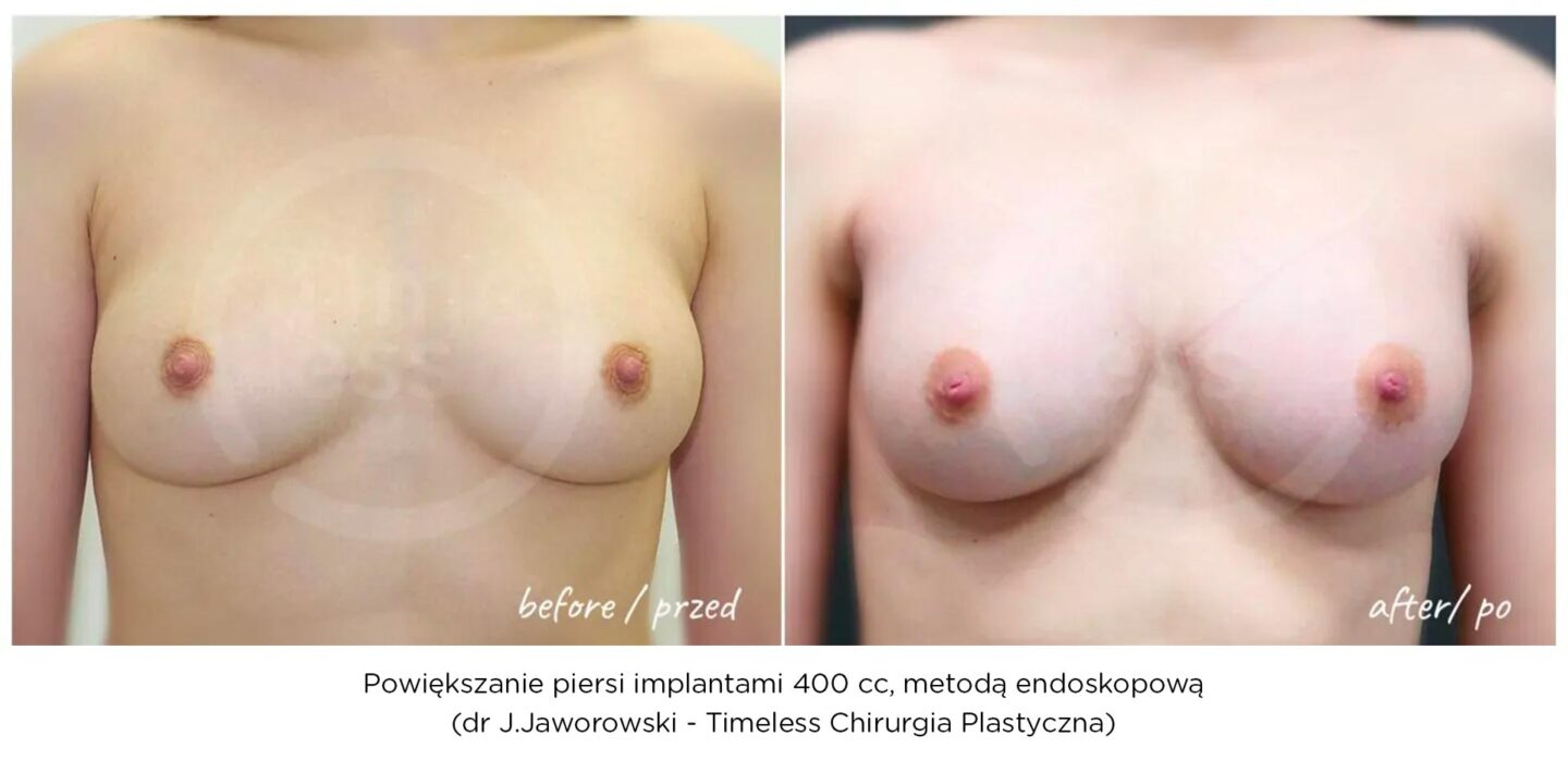 implanty piersi, powiększanie piersi metodą endoskopową