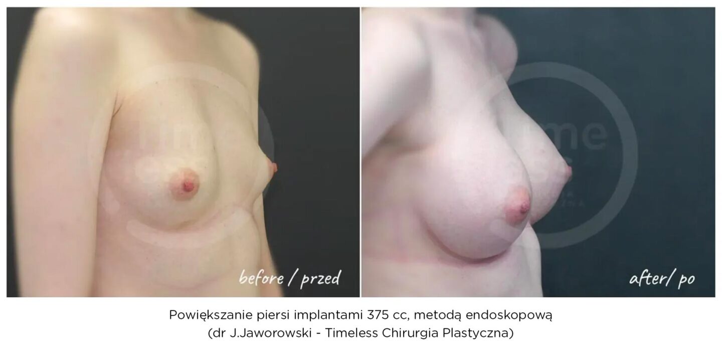 implanty piersi, powiększanie piersi metodą endoskopową