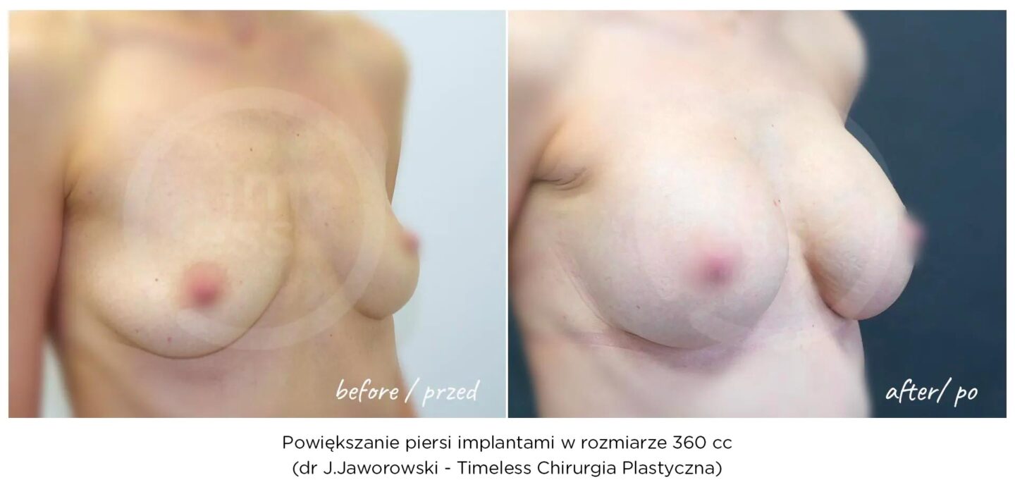 powiększanie piersi implantami, klinika timeless warszawa