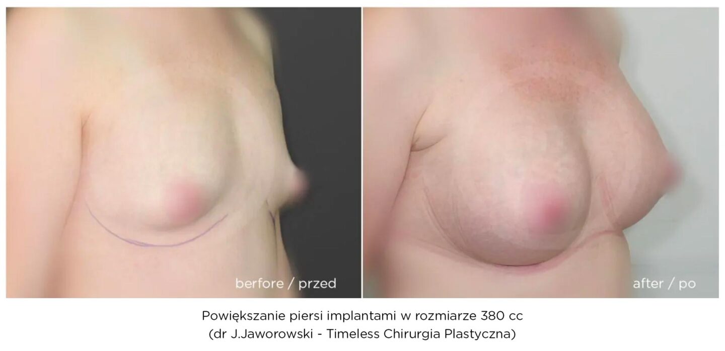 powiększanie piersi implantami, klinika timeless warszawa